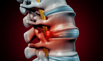 bulging-disk-treatment